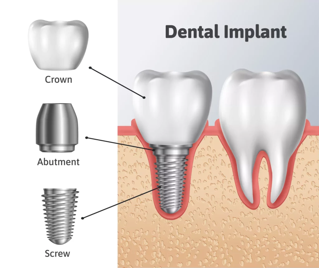 Dental Implants